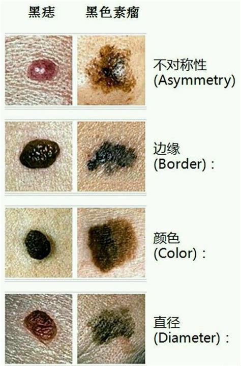 痣上面長痘痘|点痣不正规可能引发癌变：关于痣的 4 个常识